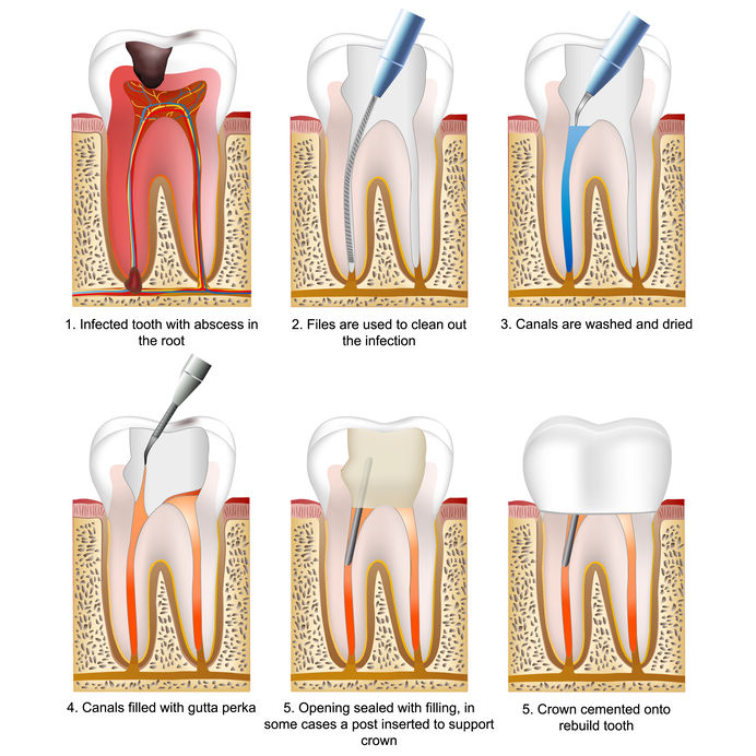 Root Canal Northborough MA - Painless Root Canal Therapy